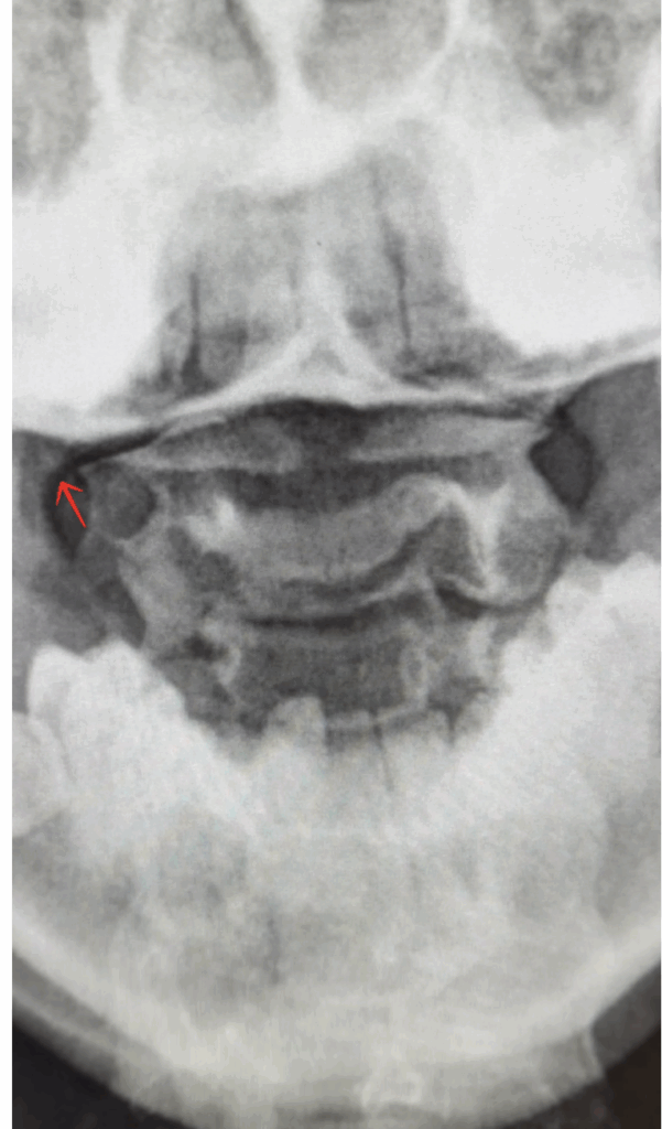 Dynamic Digital Radiography showing lateral overhang of C1 on C2 during active cervical lateral flexion